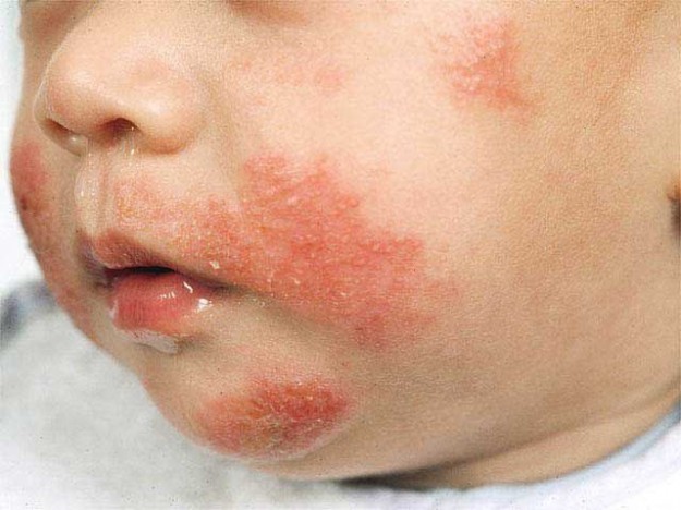 eczema-dermatite-atopica-allergia.jpg